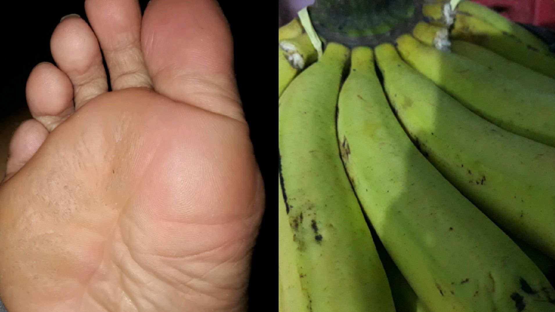 Cukup Pakai Kulit Pisang, Begini Cara Mengatasi Telapak Kaki yang Pecah